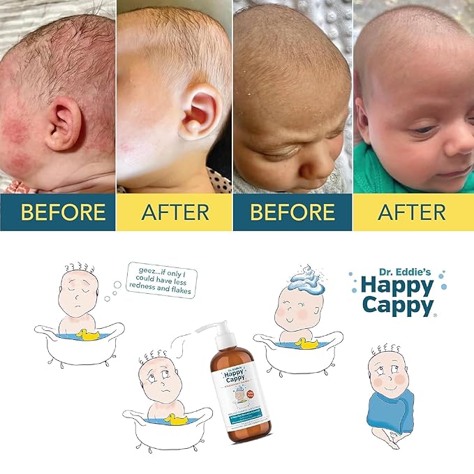 Happy Cappy Cradle Cap Medicated Shampoo and Body Wash with Comb - Baby Dandruff Shampoo, Helps Infants with Seborrheic Dermatitis, Reduces Flakes, Dermatologist Tested, Fragrance Free - 8 fl oz