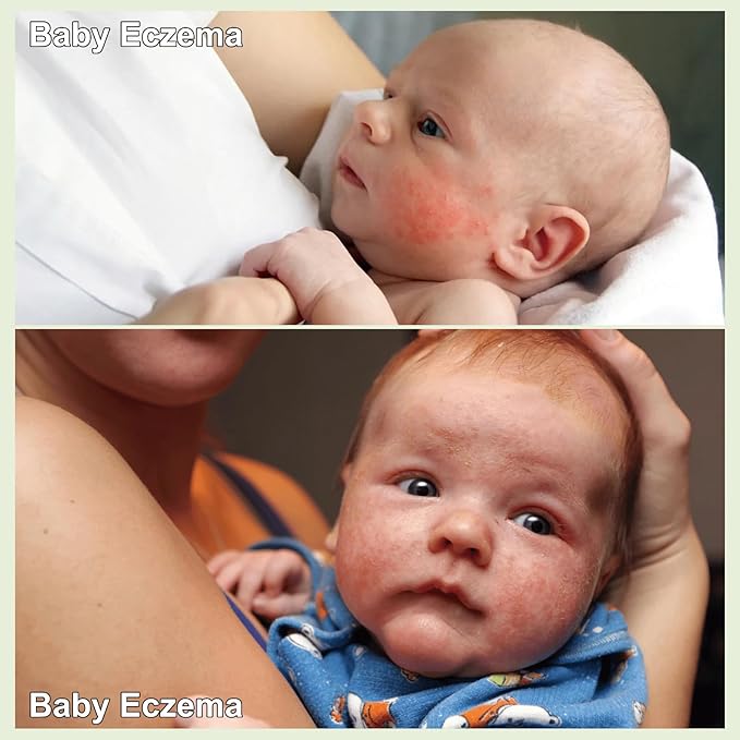 Heat Rash Care Cream for Babies | Prevents Prickly Heat, Sweat Rashes, Eczema & Skin Inflammation | Alleviating Discomfort for Babies Skin | 100ml/3.38oz (100ml/1pcs)