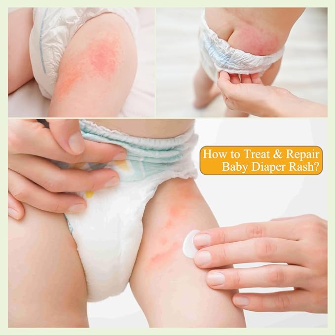 Diaper Rash Cream for Babies - Pediatrician-Recommended to Prevent, Soothe, and Treat Breakouts Diaper Rash and Flare-Ups, Baby Skin Protectant (100ml, 3.38, Fl Oz)