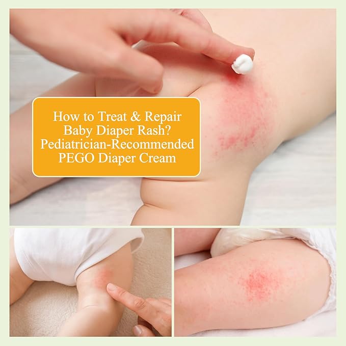 Diaper Rash Cream for Babies - Pediatrician-Recommended to Prevent, Soothe, and Treat Breakouts Diaper Rash and Flare-Ups, Baby Skin Protectant (100ml, 3.38, Fl Oz)