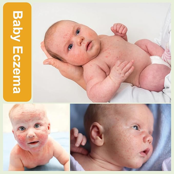 AOAO Baby Eczema Cream - Kids Eczema Therapy & Relief Body Cream, Nourishing Skin Protectant Soothes & Relieves Dry, Hypoallergenic, Fragrance & Steroid-Free (100ml, Fl Oz, 3.38) (White+)