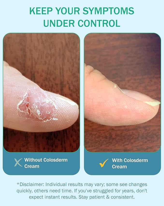 Eczema Cream for Kids & Adults, Colloidal Oatmeal & Colostrum Daily Moisturizing Body Lotion for Sensitive Skin, Soothing Eczema Treatment Relief for Dry & Itchy Skin, Steroid- & Fragrance-Free, 4 oz