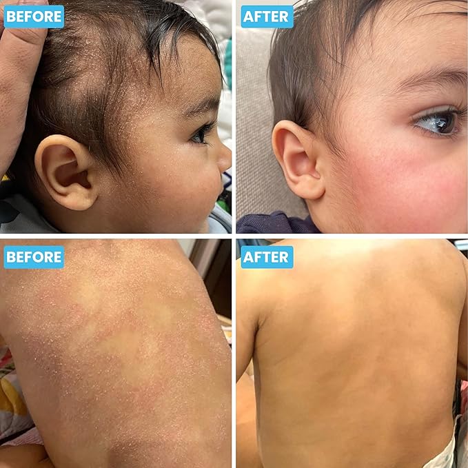 Grahams Natural Baby Eczema Body and Bath Oil - Treat Eczema & Cradle Cap, Relief for Itchy, Dry Skin - Clinically Proven Formula - For Ages 0+ Months to 12 Years (1 x 100ml)